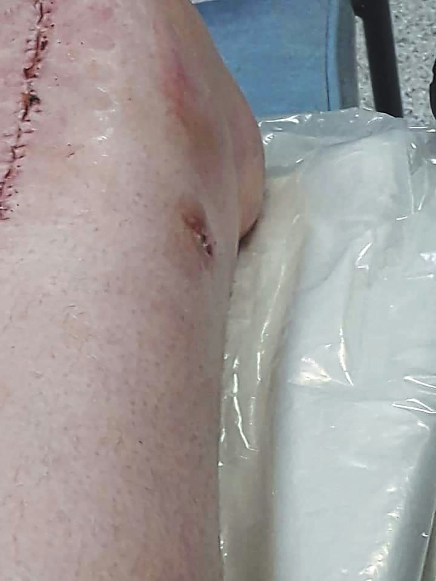 saved son, lost leg