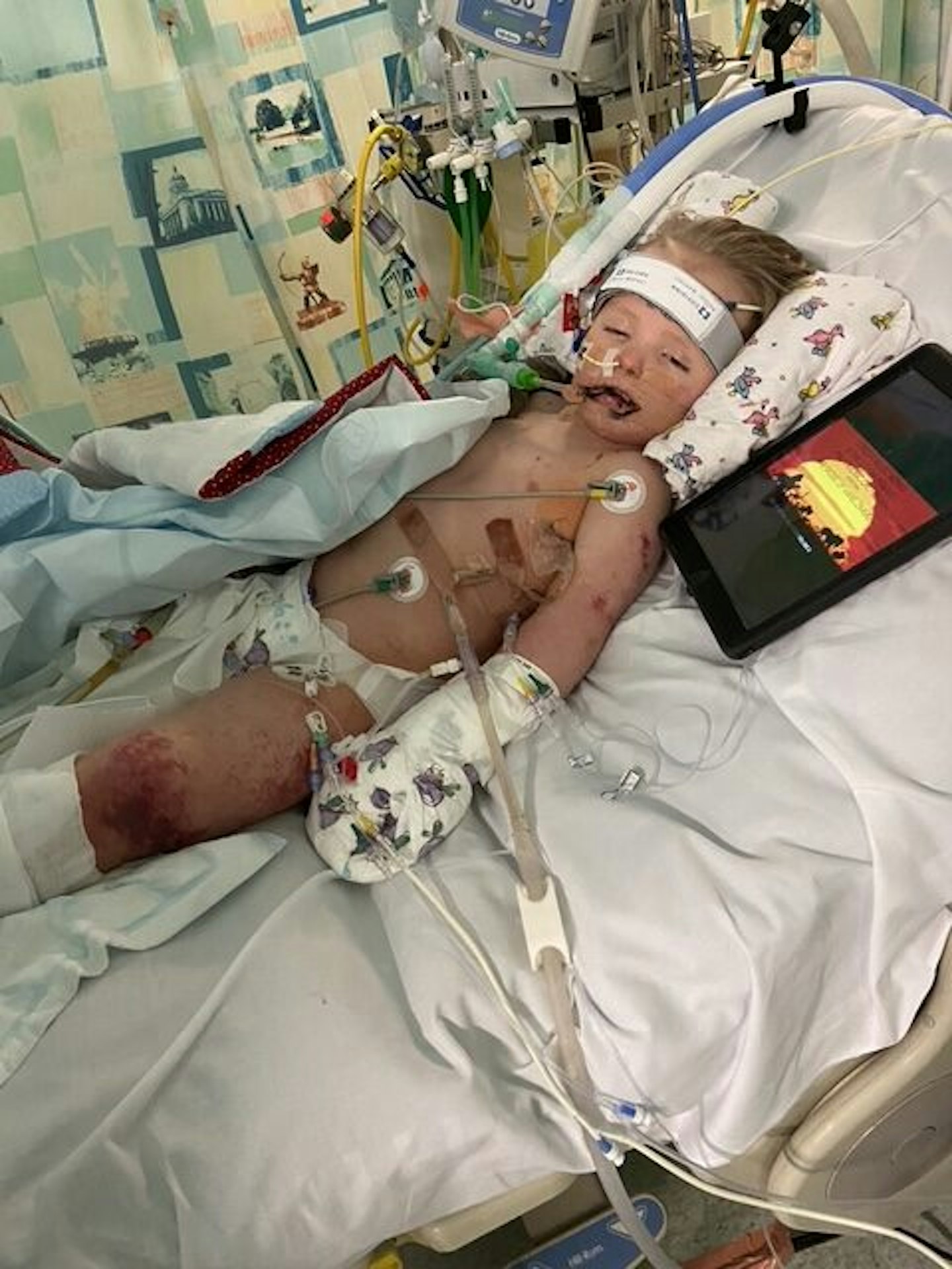 Lost legs to sepsis
