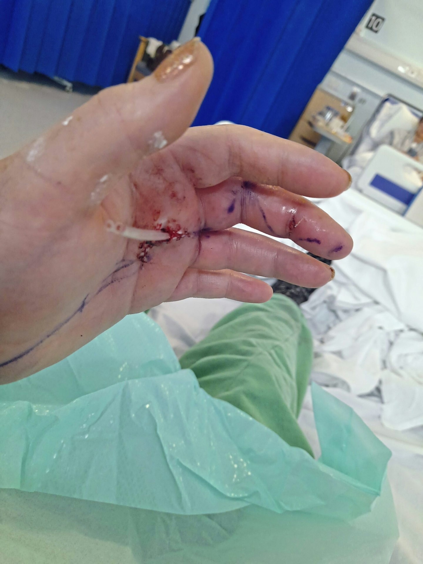 Guines pig bite left me in hospital