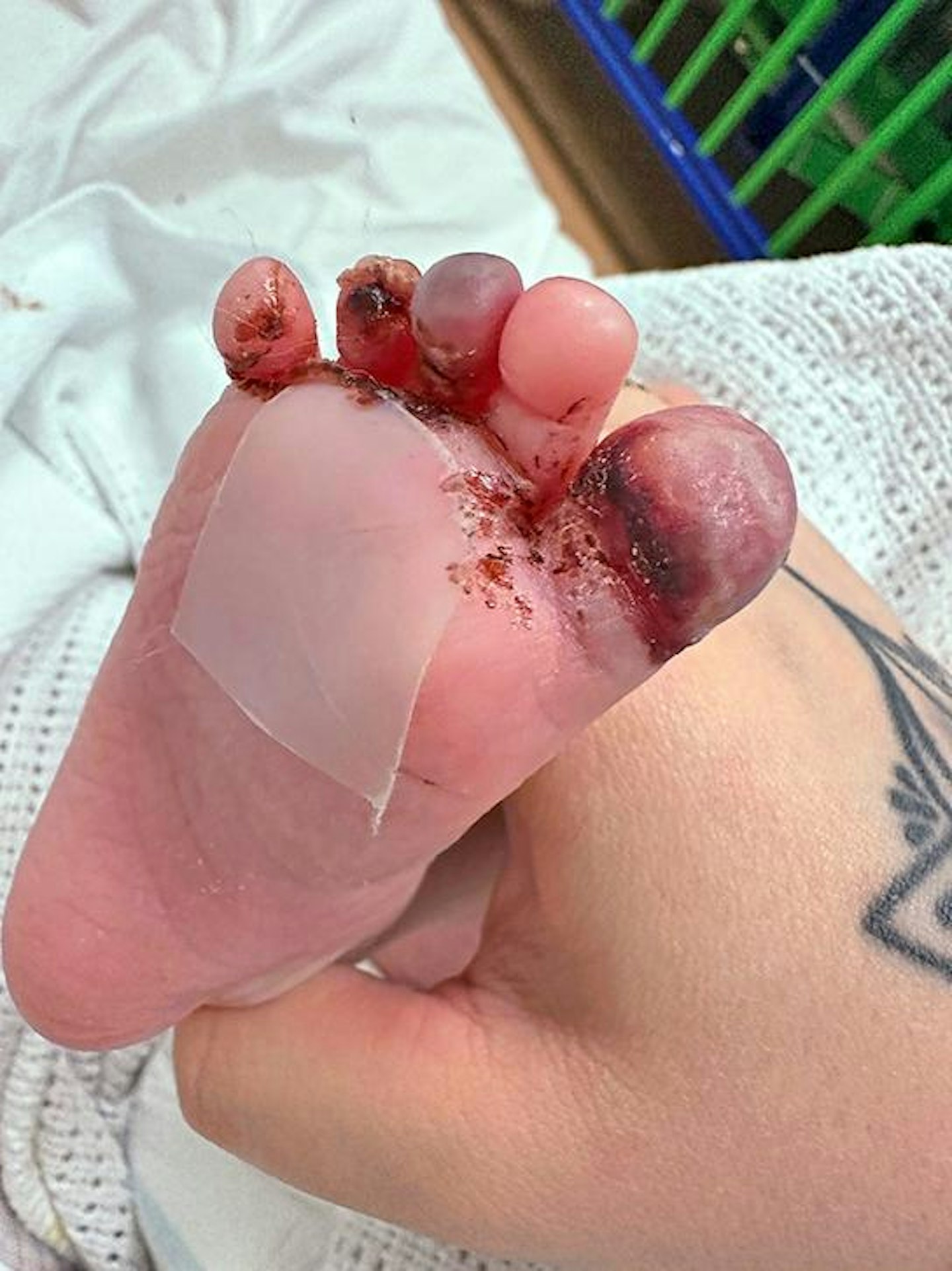 baby's foot turned black