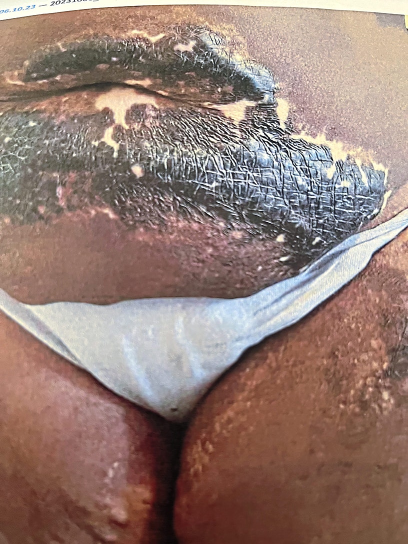 Attacked with hot oil