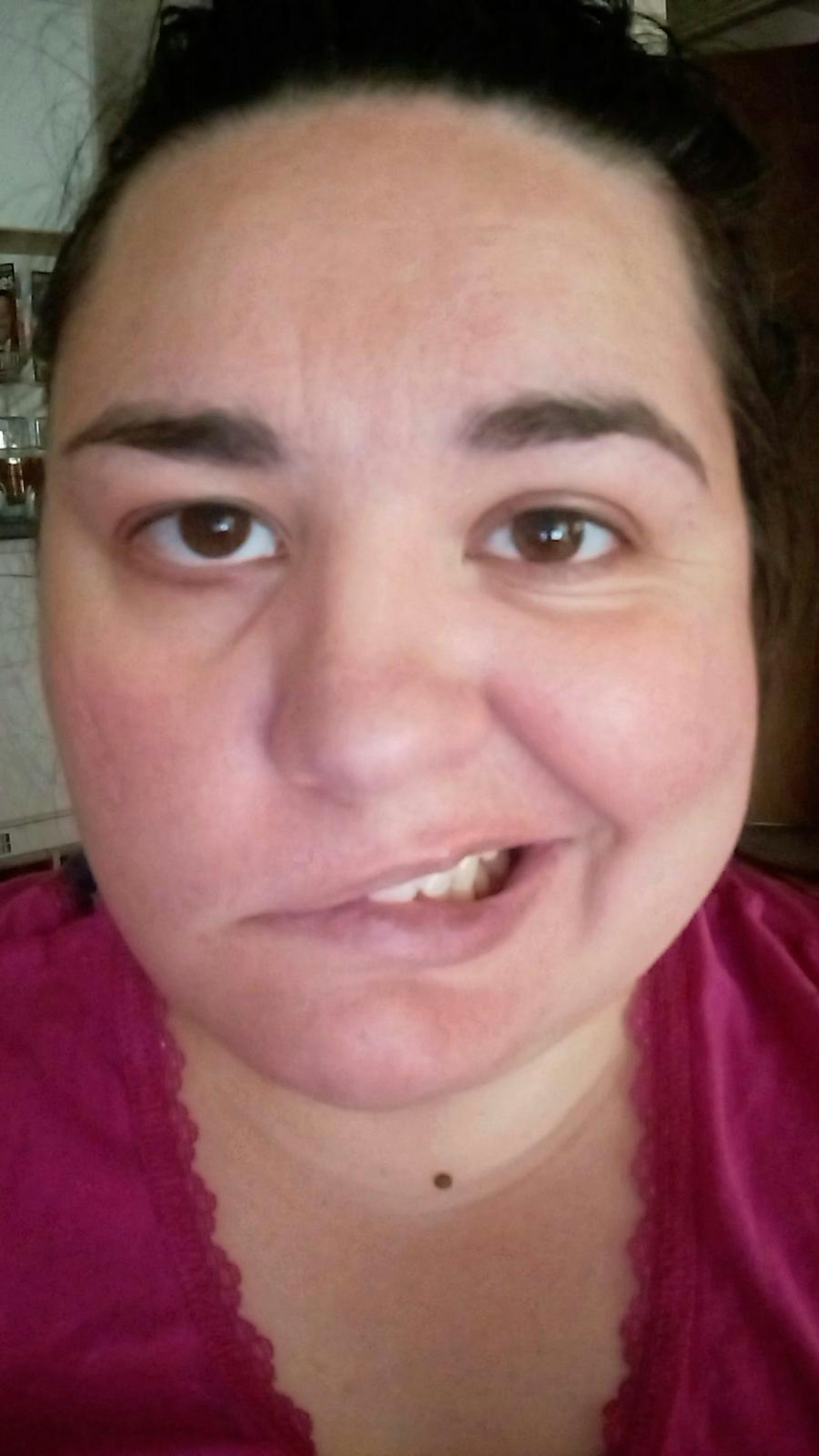 bells palsy