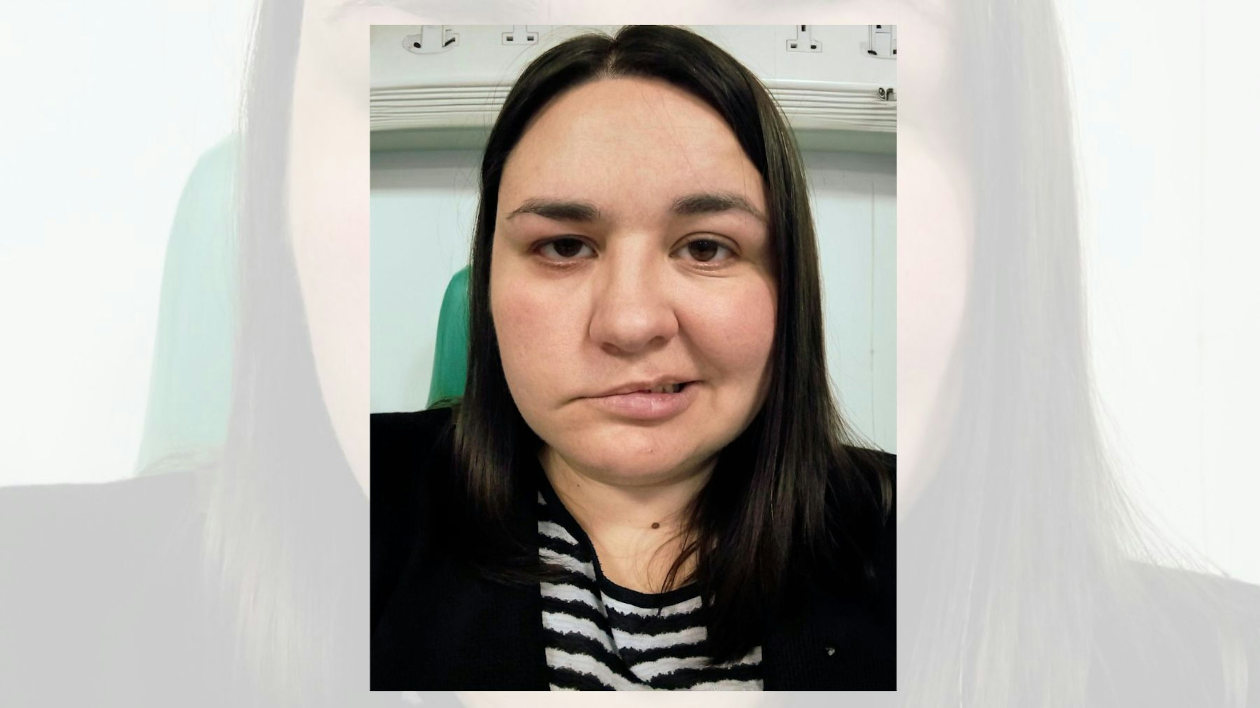 Bells Palsy