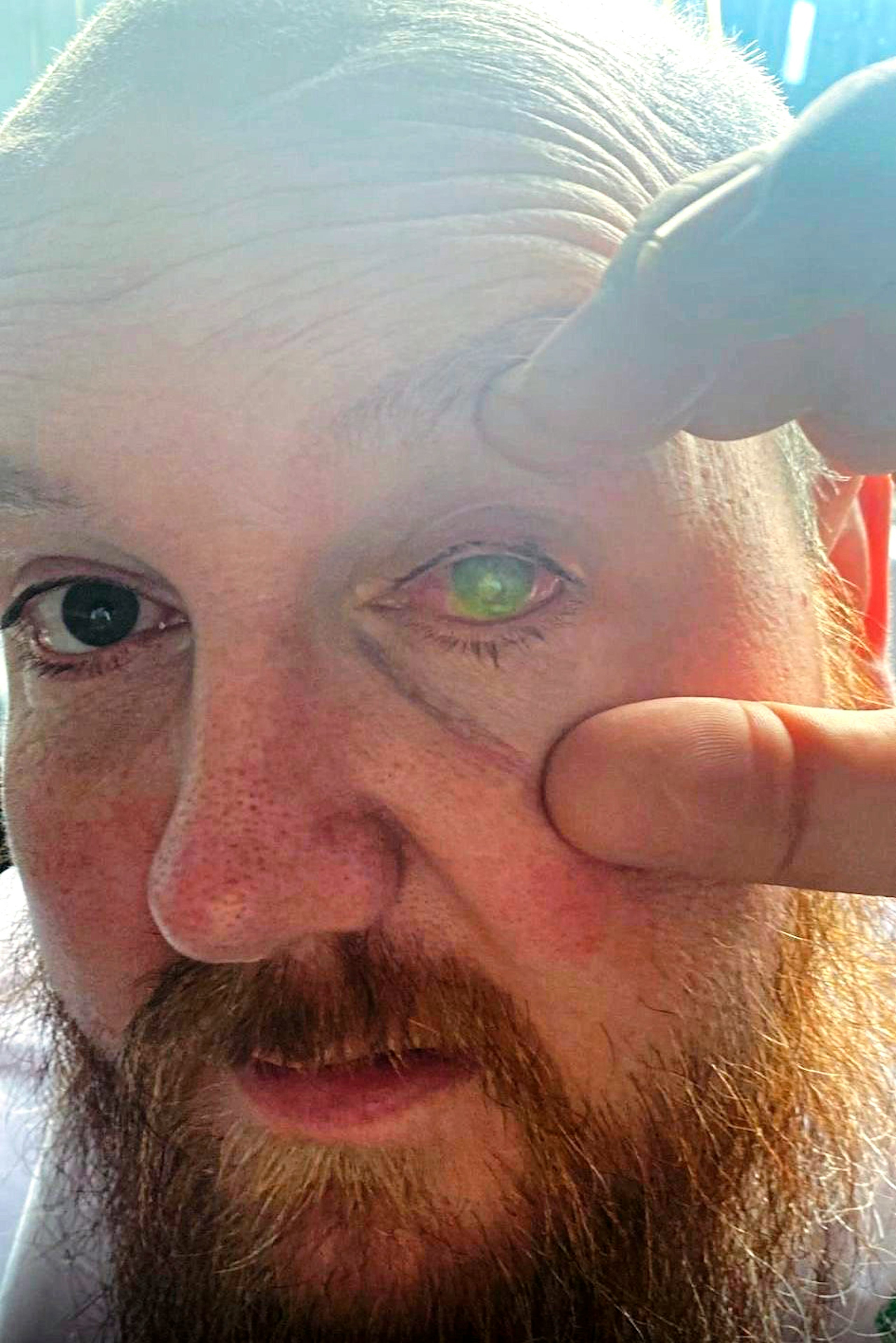 Acid attack victim eye saved by placenta