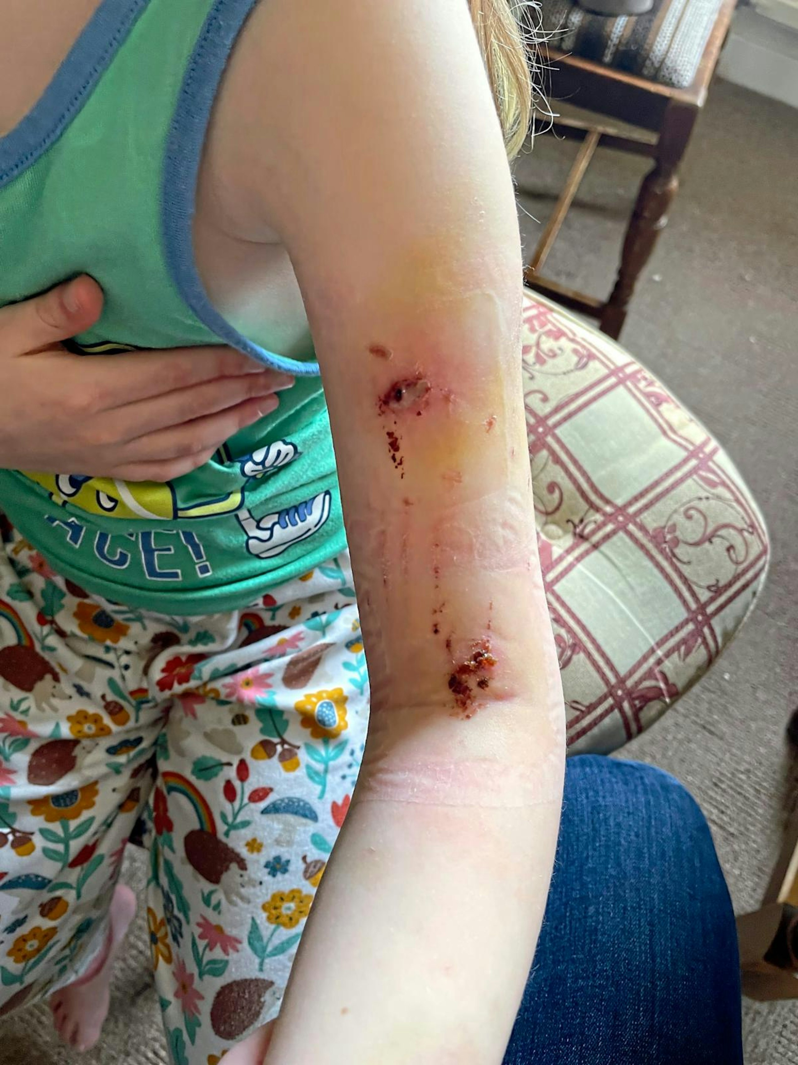 mauled by dog