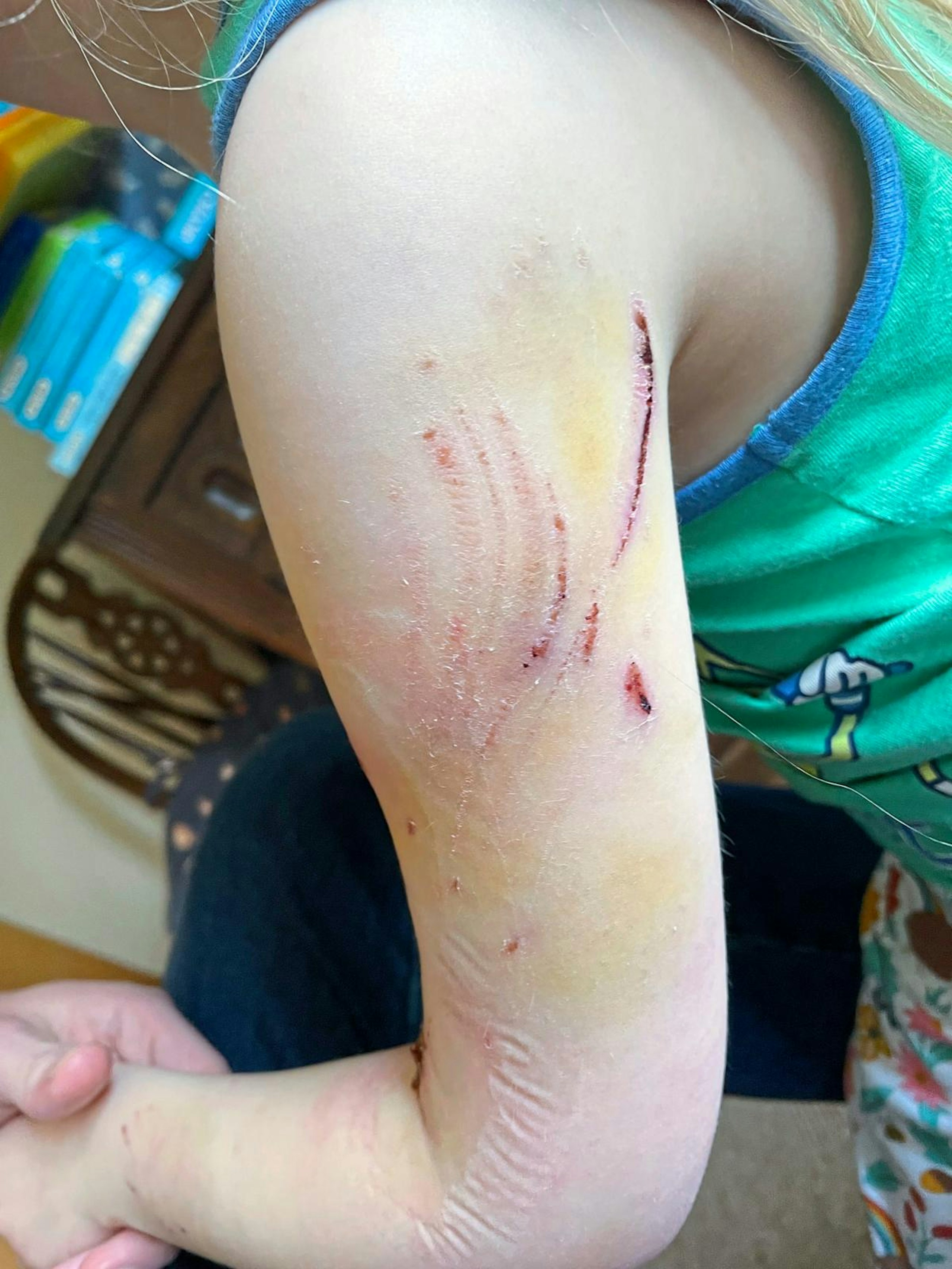 mauled by dog