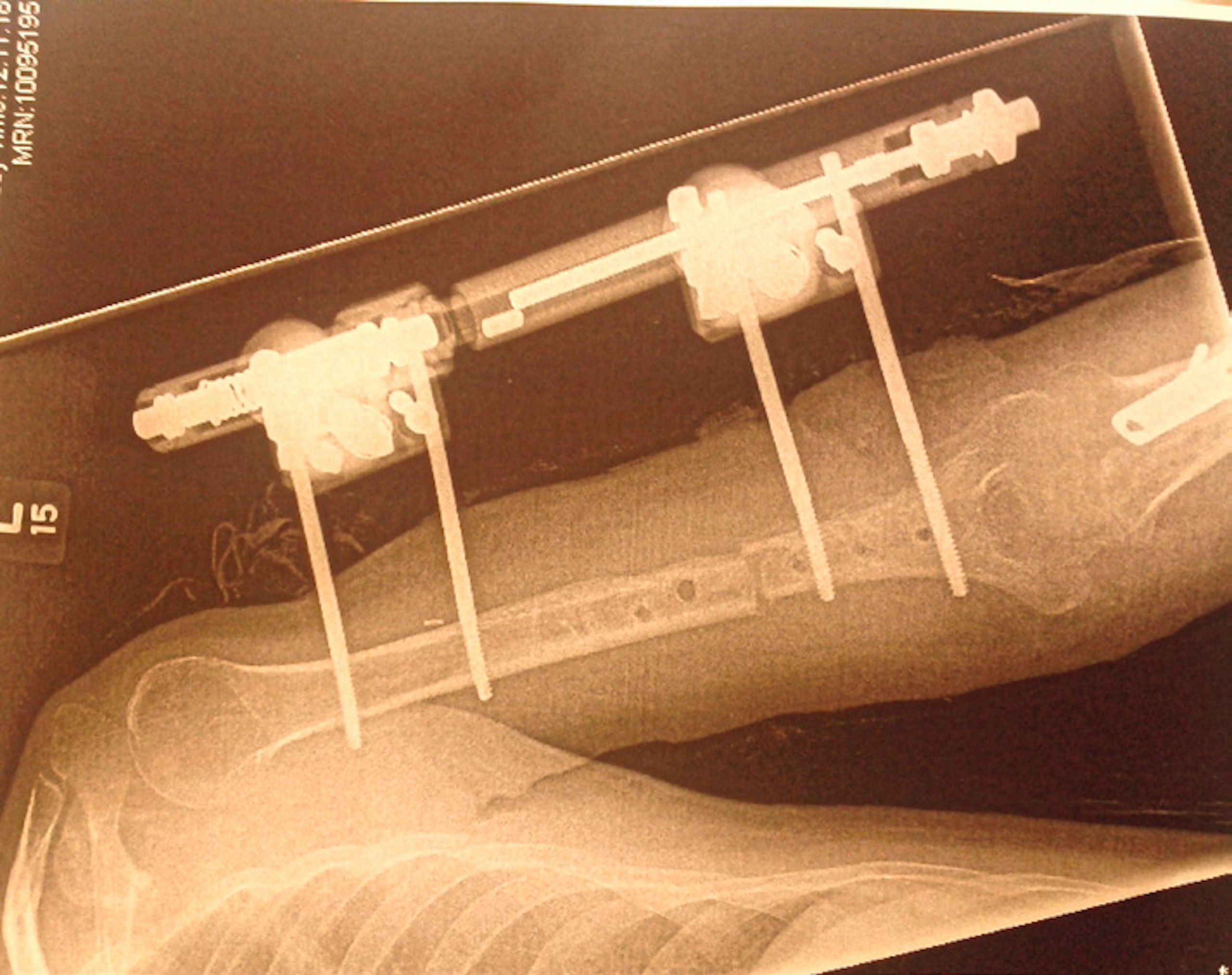 Scenes from Guy’s recovery, and the rebuilding of his shattered left arm.