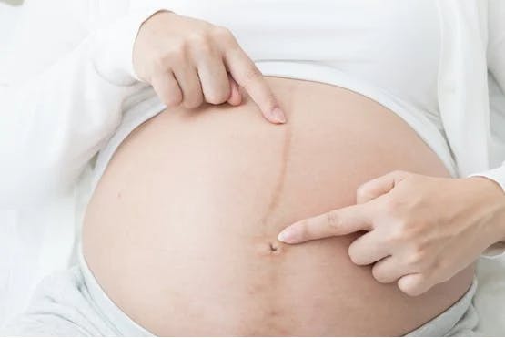 black line on tummy during pregnancy and gender of fetus