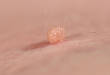 Skin Tags During Pregnancy All Your Questions Answered Pregnancy Mother Baby